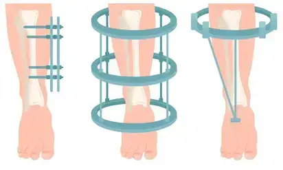 Beinverlängerung (Ästhetisch und Medizinisch)