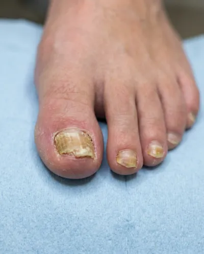 Nagelpilz – Behandlung